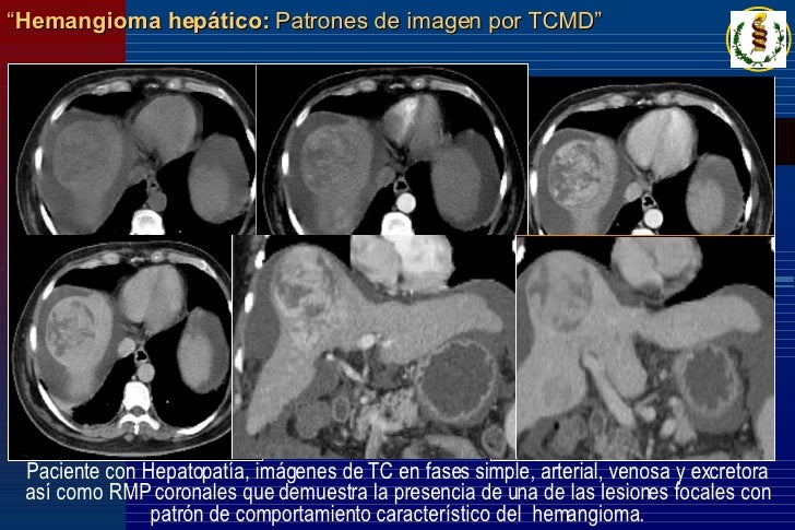 hemangioma hepatico